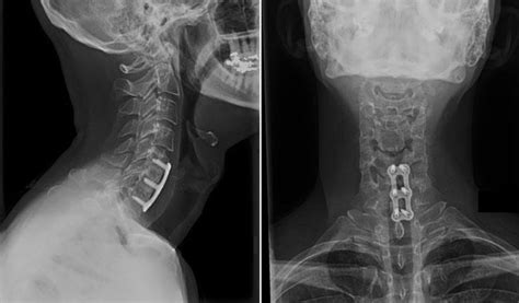 Anterior Cervical Spinal Fusion Surgery