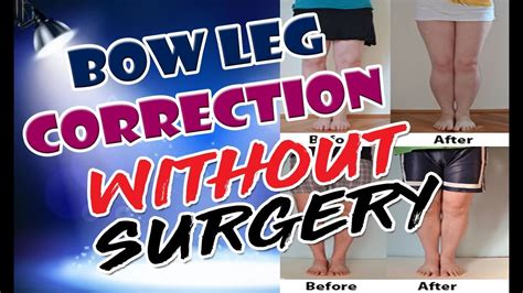 Bow Legs Correction Without Surgery Best Result For Bow Leg Correction Without Surgery YouTube