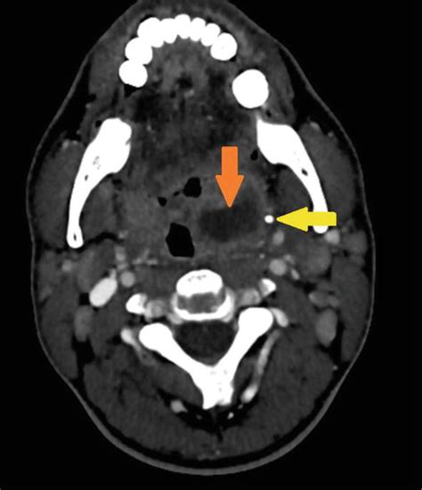 Peritonsillar And Intratonsillar Abscess A Review On Clinical Features