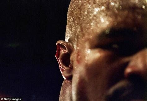 Evander Holyfields Ear After He Was Bitten By Mike Tyson During Their