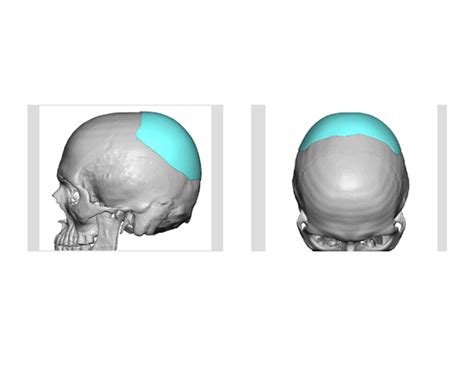 Plastic Surgery Case Study Custom Skull Implant For Occipital Dents