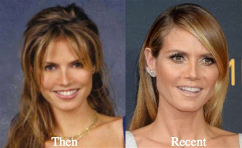 Heidi Klum Plastic Surgery Before And After Photos Latest Plastic
