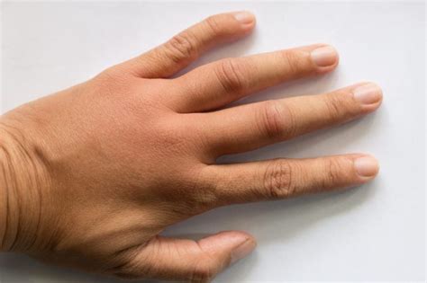 Diseases Your Hands Can Predict Readers Digest