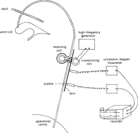 A New Method For Measuring Cerebrospinal Fluid Flow In Shunts In