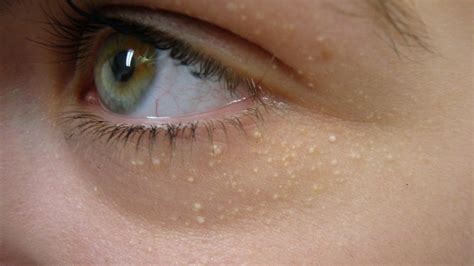 Home Remedies For Milia How To Get Rid Of Milia Milia On Eyelid