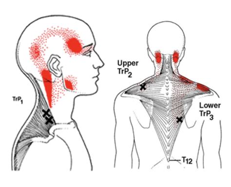 Trigger Points Dry Needling Physio For All