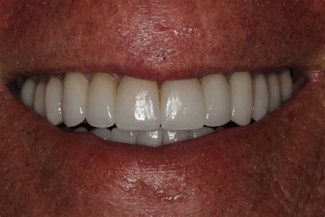 Patient Gallery Before And After Photos Weston Spencer Dds