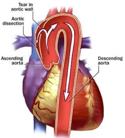 Marfan Syndrome Cardiac Health