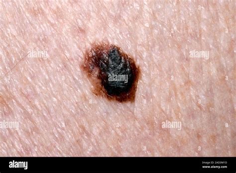 Melanoma Skin Cancer Close Up Of A Superficial Spreading Malignant