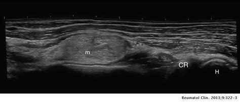 Giant Lipoma Of The Forearm As A Cause Of Extracarpal Compression Of