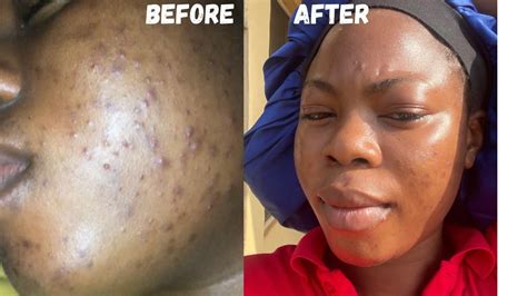 How I Cleared My 5 Years Acne And Hyperpigmentation How I Got Rid Of