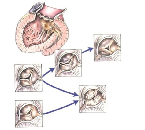 Aortic Stenosis Progression Top 5 Facts Patients Should Know Aortic