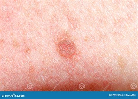 Nevus Or Papilloma Or Mole Or Melanoma Or Keratosis On The Skin Of