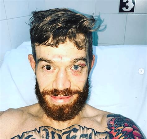 Pic Ufc Fighter Suffers Horrific Eye Injury Nsfw