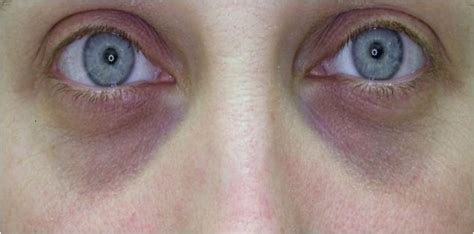 What Causes Dark Under Eye Circles What Causes This