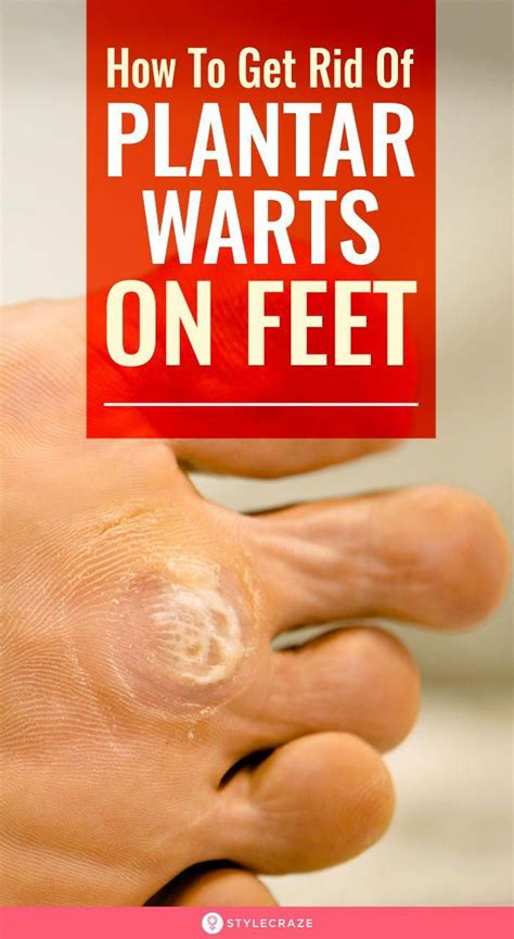 How To Get Rid Of Plantar Warts On Feet Naturally There More Than A