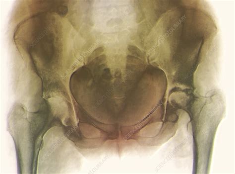 Rheumatoid Arthritis Of The Hip X Ray Stock Image C0095374
