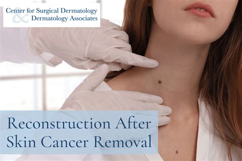 Reconstruction After Skin Cancer Removal In Central Ohio
