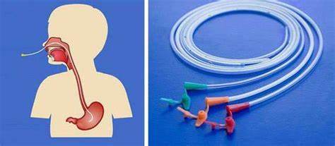 Диета стеноз пищевода Стеноз пищевода: причины, симптомы и лечение в статье абдоминального Стеноз пищевода: причины, симптомы и лечение в статье абдоминального Диета стеноз пищевода