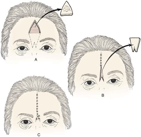 Reconstruction Of The Forehead Plastic Surgery Key