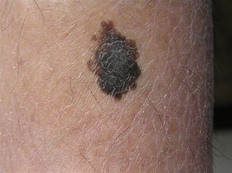 Melanoma Skin Cancer Symptoms