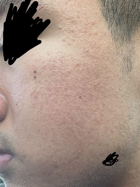 Skin Concerns Any Idea On What This Could Be Skincareaddiction