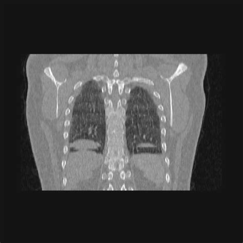 Bronchial Atresia Radiopaedia 60685 68439 Coronal Lung Window Nc
