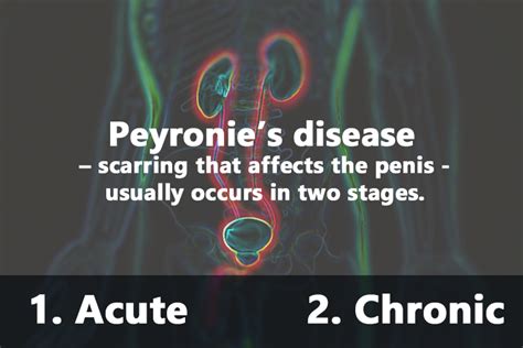Peyronie S Disease