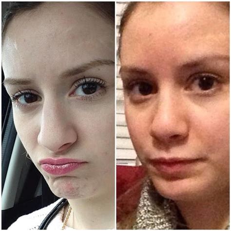 Septoplasty Before And After Photos 12 Rhinoplasty Cost Pics