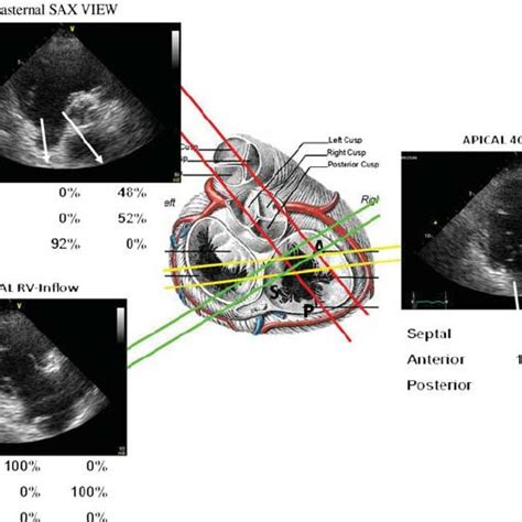 Normal Tricuspid Valve Leaflets Visualized By Real Time Download