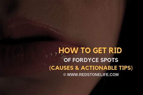 How To Get Rid Of Fordyce Spots Causes And Actionable Tips Fordyce