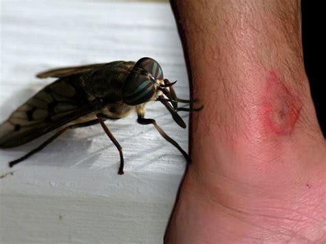 Horsefly Bite Pictures On Humans Picturemeta