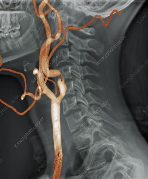 Stenosis Of Carotid Artery D Ct Scan Stock Image C