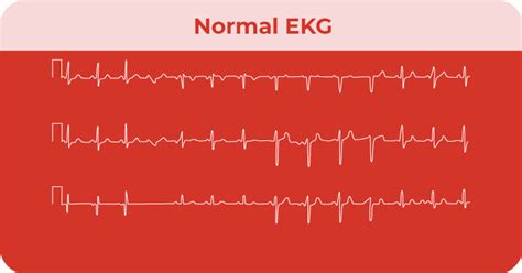 What Does A Heart Attack Look Like On An Ekg Cardiacdirect