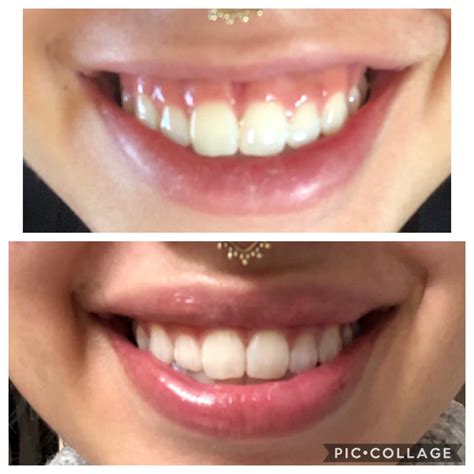 How To Fix A Gummy Smile With Lip Fillers Smile Gummy Smile Filler There Are Different