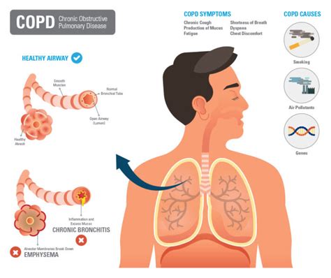 Asthma And Copd Legacy For Airway Health