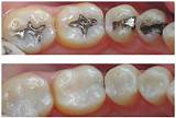 Pictures of Dental Silver Fillings