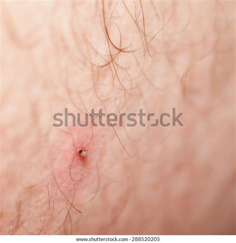 Tick Head Sticking Human Skin Stok Fotoğrafı 288520205 Shutterstock
