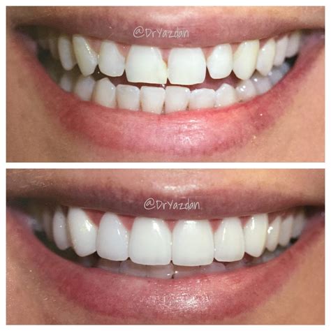 How To Care For Your New Dental Veneers Center For Restorative