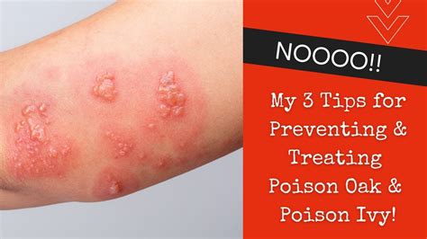 3 Tips For Preventing And Treating Poison Oak And Poison Ivy Rashes