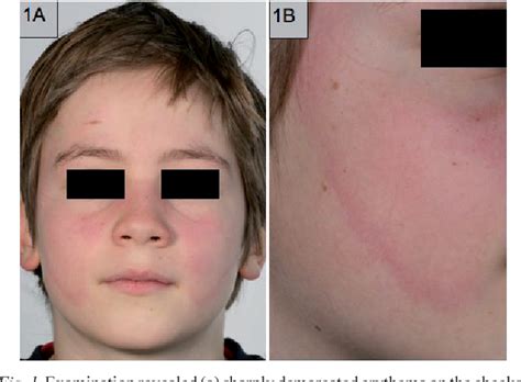Figure 1 From Butterfly Rash In A Young Boy A Quiz Semantic Scholar