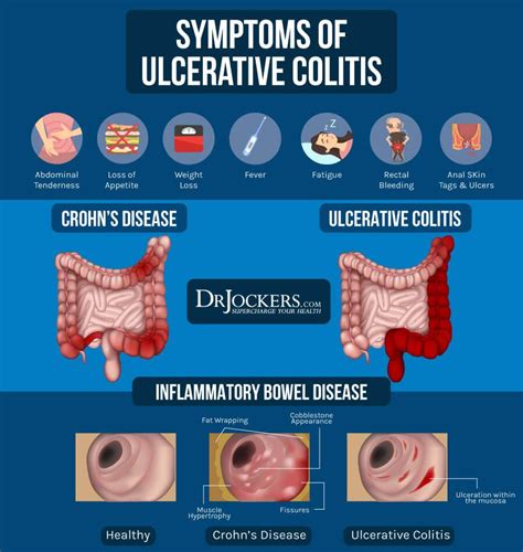 Ulcerative Colitis Causes Symptoms And Natural Support Strategies Artofit