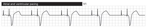 Interpretation Of Pacemaker ECG ECG ECHO
