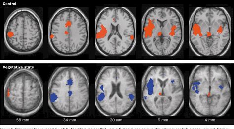 Pdf Brain Function In Coma Vegetative State And Related Disorders