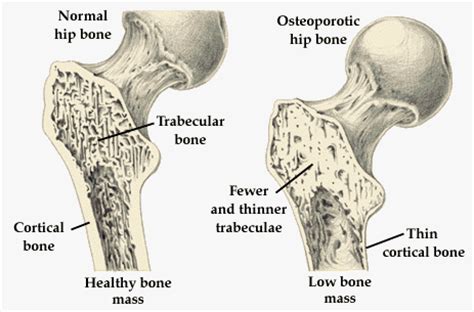 This feature extractor is used to encode the network's input into a certain feature representation. What is the Osteoporosis and How Common Is It to be ...