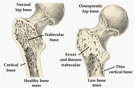 In this article series we will concentrate on ospf area types and their configuration examples on packet tracer. What is the Osteoporosis and How Common Is It to be ...