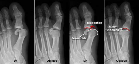 Dislocated Pinky Toe Xray