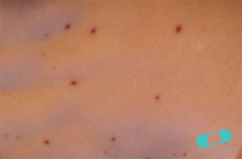 Tiny Pinpoint Red Dots On Skin Caused By Viruses Polizlifestyle