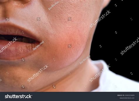 Swelling Cheek Asian Young Man Abscess Stock Photo 2243153429