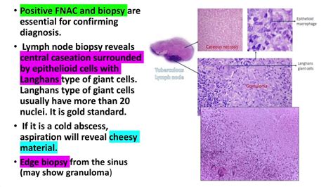 Tuberculous Lymphadenitiscervical Lymphadenitis Treatment Diagnosis